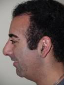 Chin Implant & Nose Job After (c) Plastic-Surgery-Of-The-Face nose job insurance