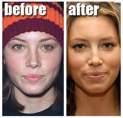 Nose Job Photobucket